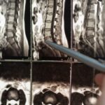 Is cannabis beneficial for degenerative disc disease and back pain? 